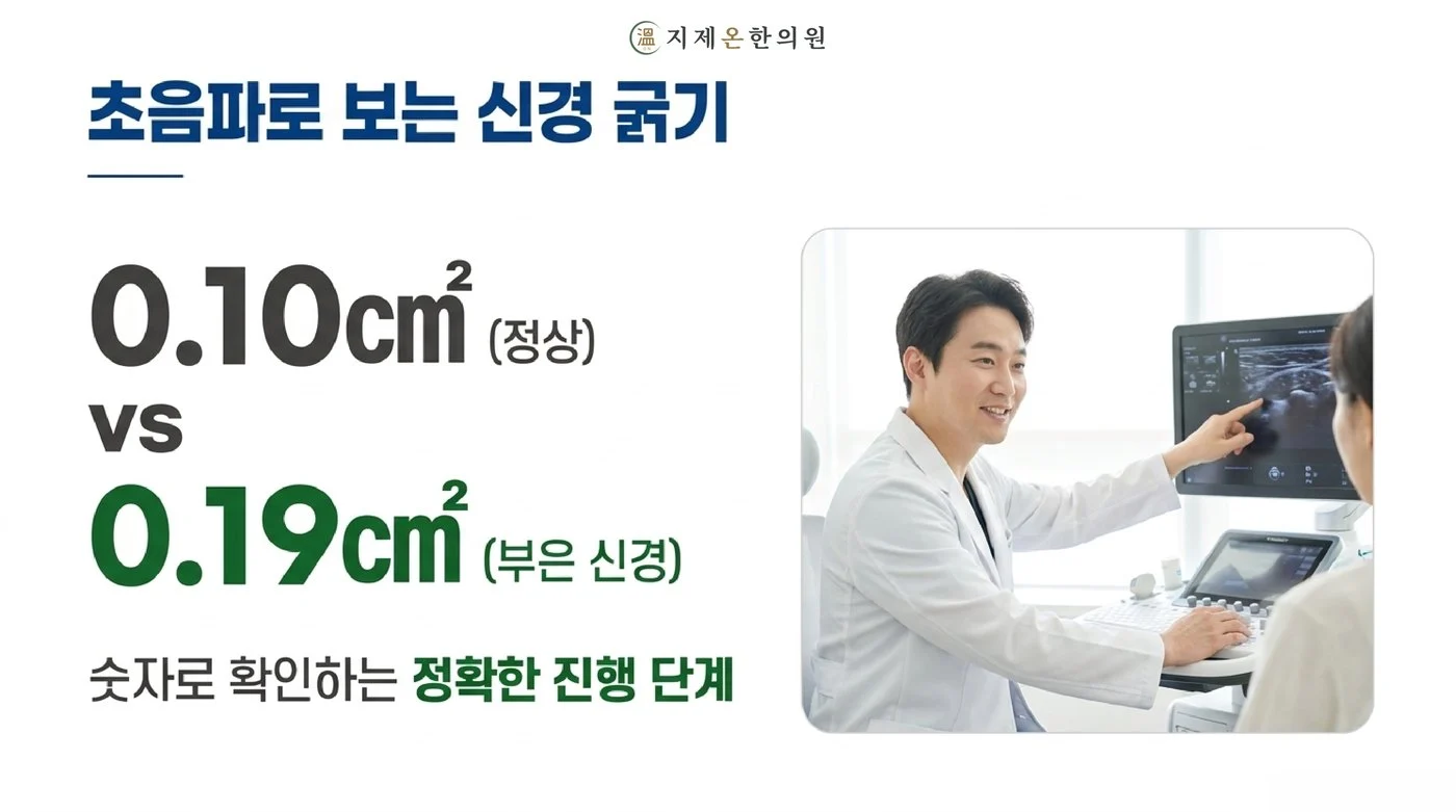 초음파로 잰 정중신경 단면적, 정상 0.10㎠와 부은 신경 0.19㎠의 비교