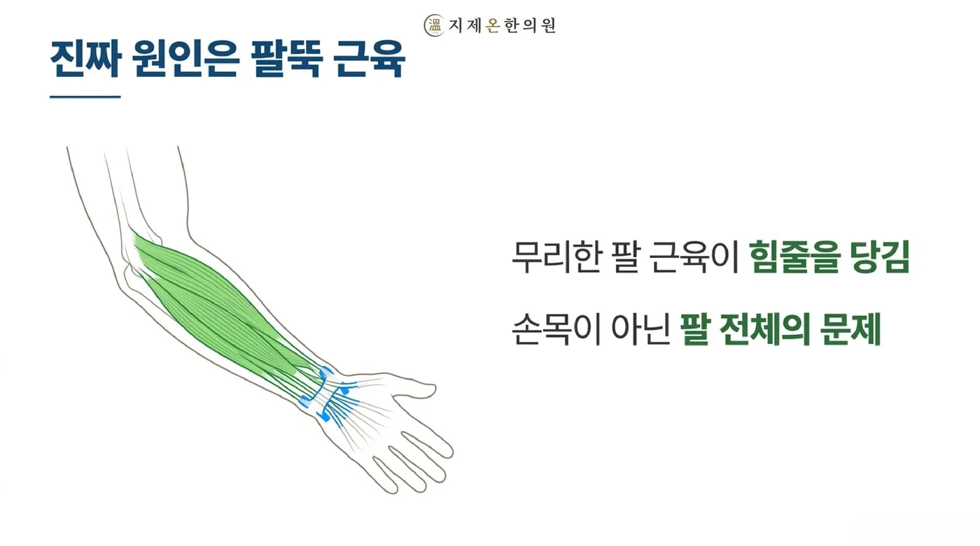 무리한 팔뚝 근육이 힘줄을 당겨 손목이 아니라 팔 전체의 문제가 되는 구조