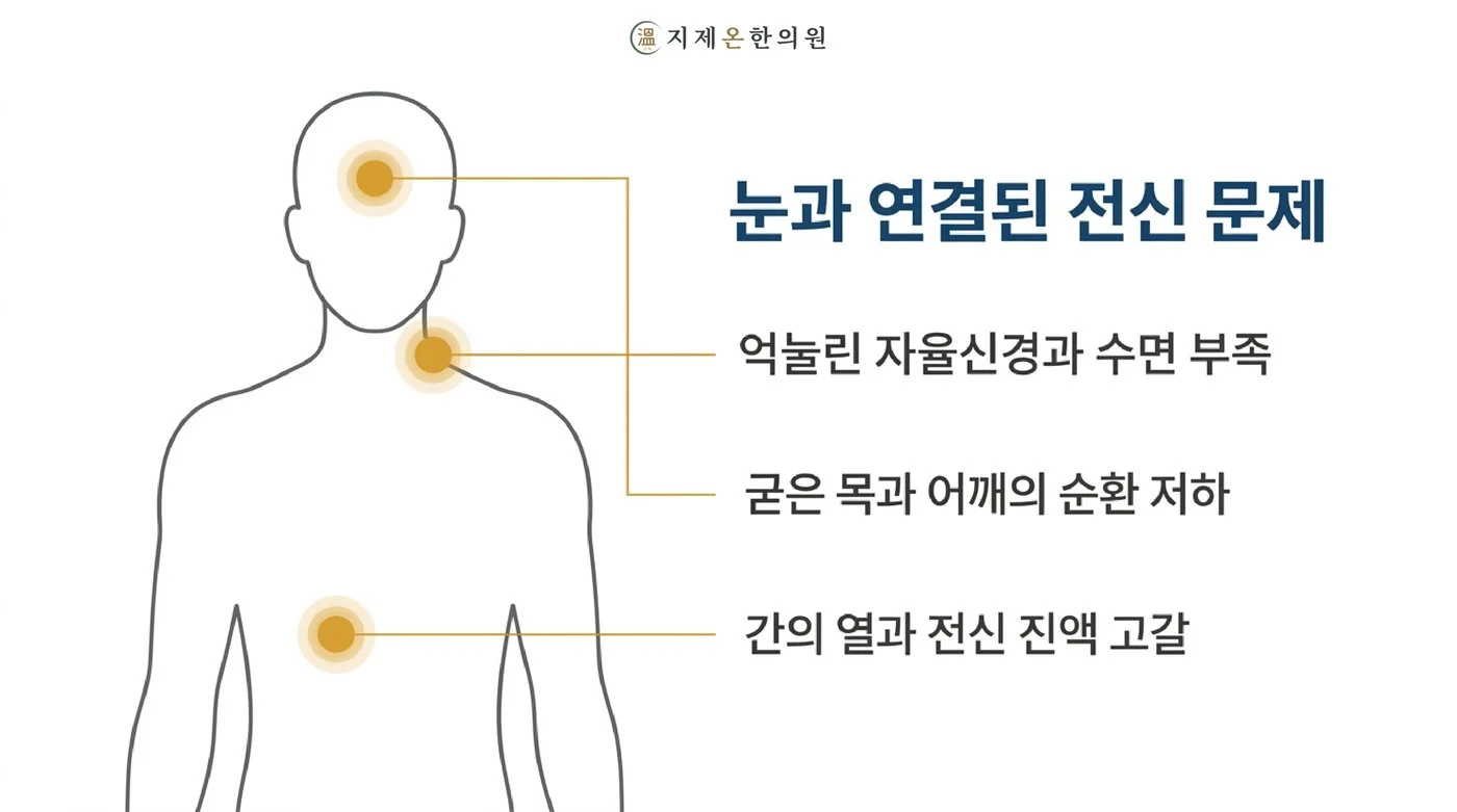 억눌린 자율신경과 수면 부족, 굳은 목과 어깨의 순환 저하, 간의 열과 진액 고갈처럼 눈과 연결된 전신 문제