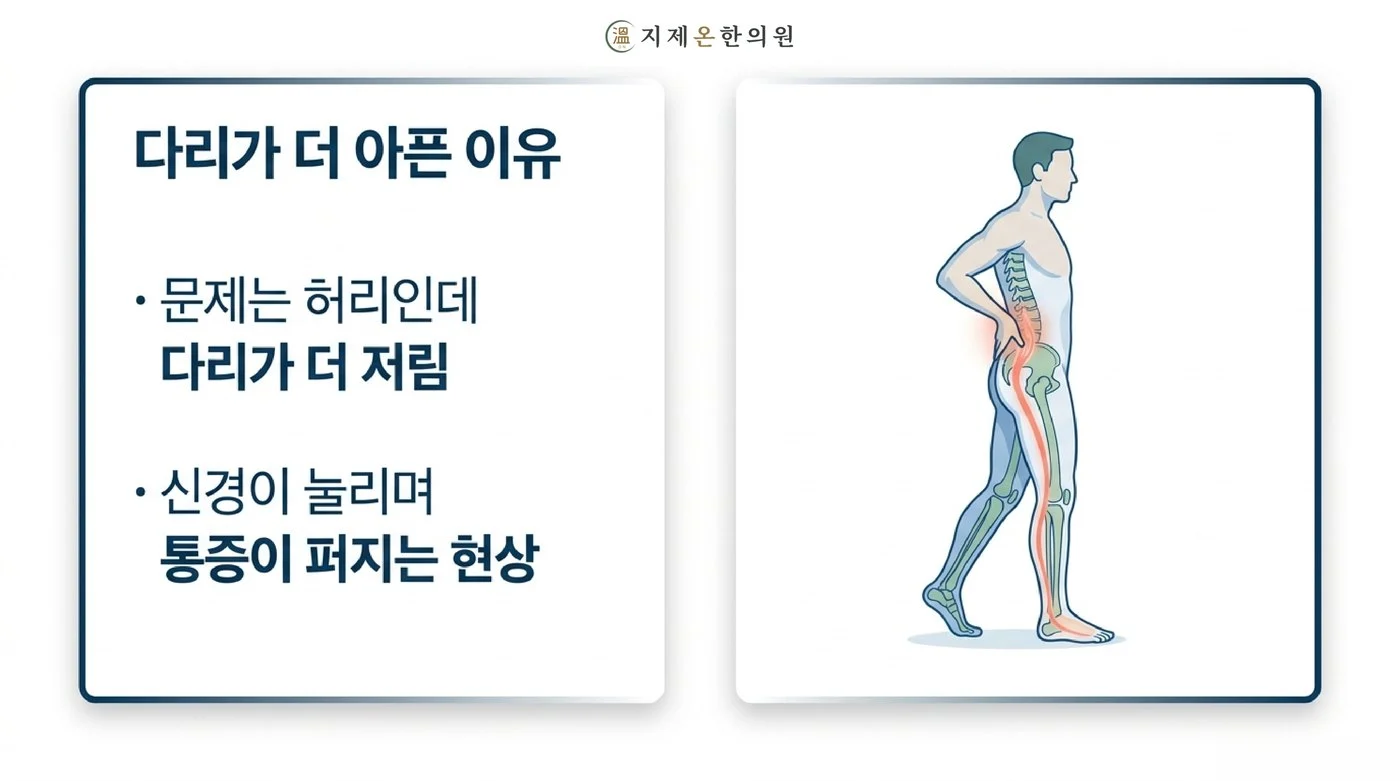 허리에서 눌린 신경을 따라 엉덩이와 다리까지 통증이 퍼지는 허리디스크 방사통