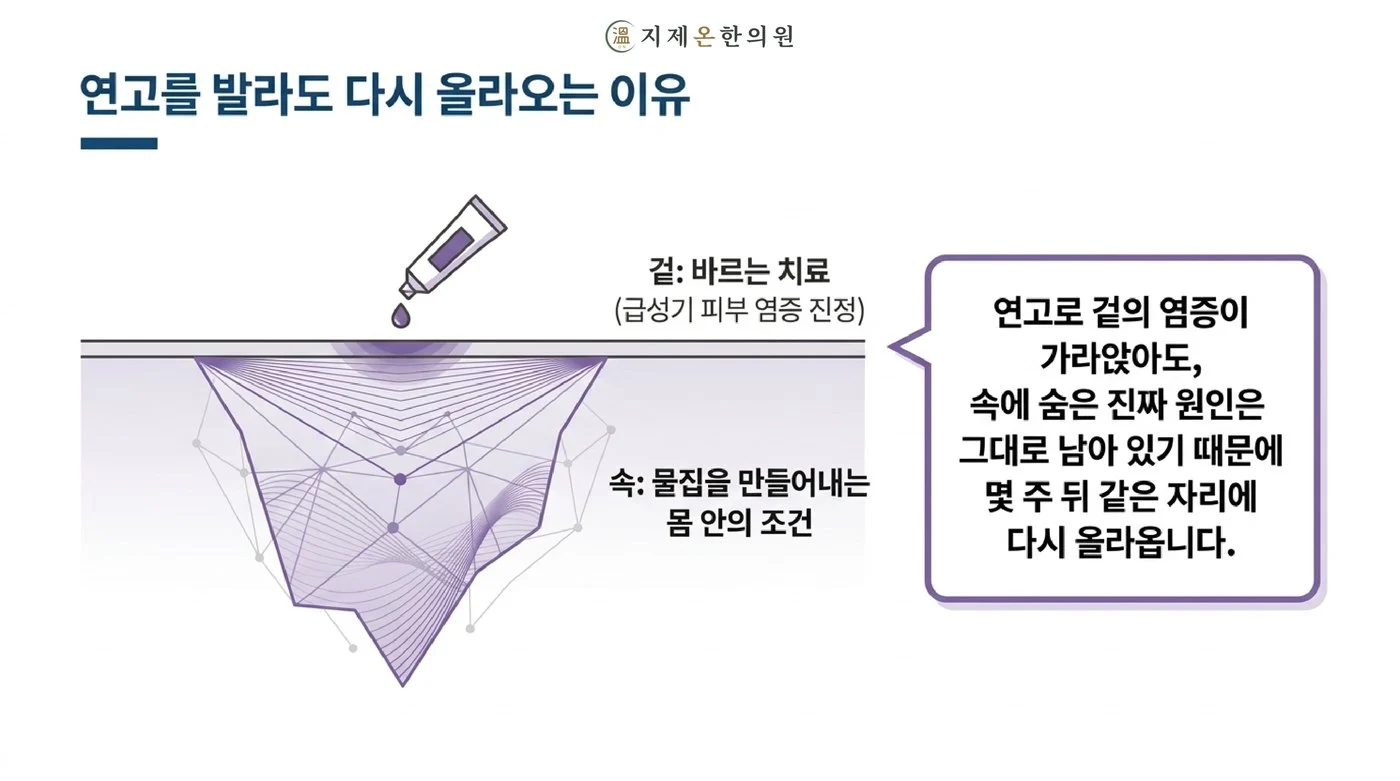 연고로 겉의 염증이 가라앉아도 물집을 만들어 내는 몸 안의 조건은 남아 있어 같은 자리에 다시 올라온다는 설명