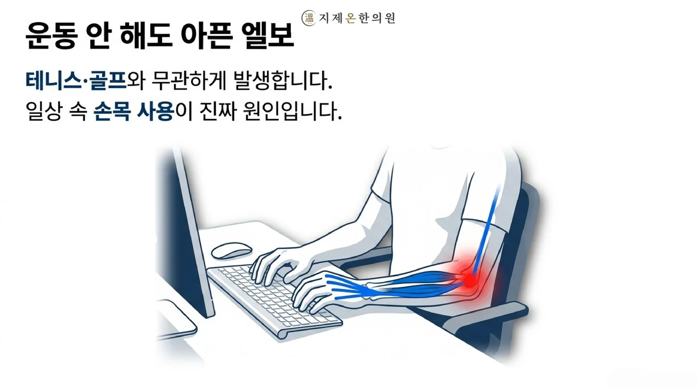 테니스·골프와 무관하게 키보드와 마우스처럼 손목을 반복해서 쓰다 생기는 팔꿈치 통증