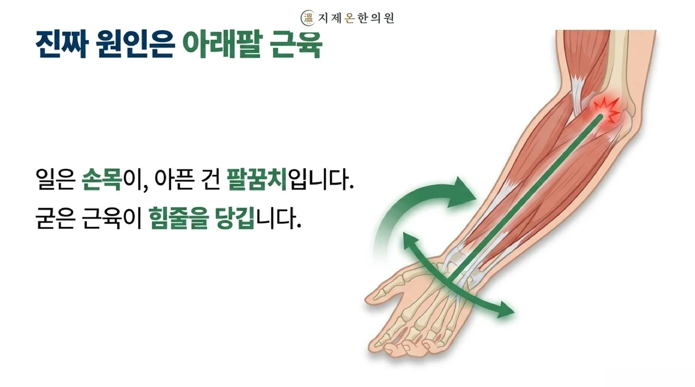 일은 손목이 하고 아픈 건 팔꿈치, 굳은 아래팔 근육이 팔꿈치 힘줄을 잡아당기는 원리