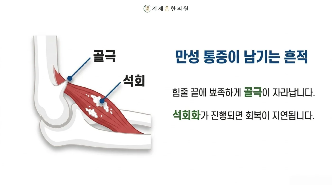 오래 반복된 팔꿈치 통증에서 힘줄 끝에 자라난 골극과 힘줄 안의 석회화