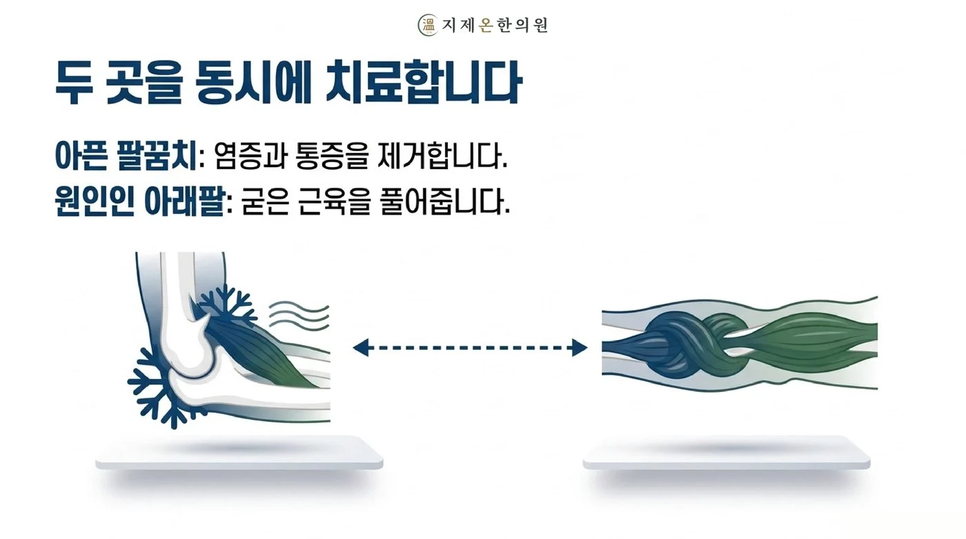 아픈 팔꿈치의 통증은 가라앉히고 원인이 된 아래팔의 굳은 근육은 풀어 주는 두 곳 동시 치료