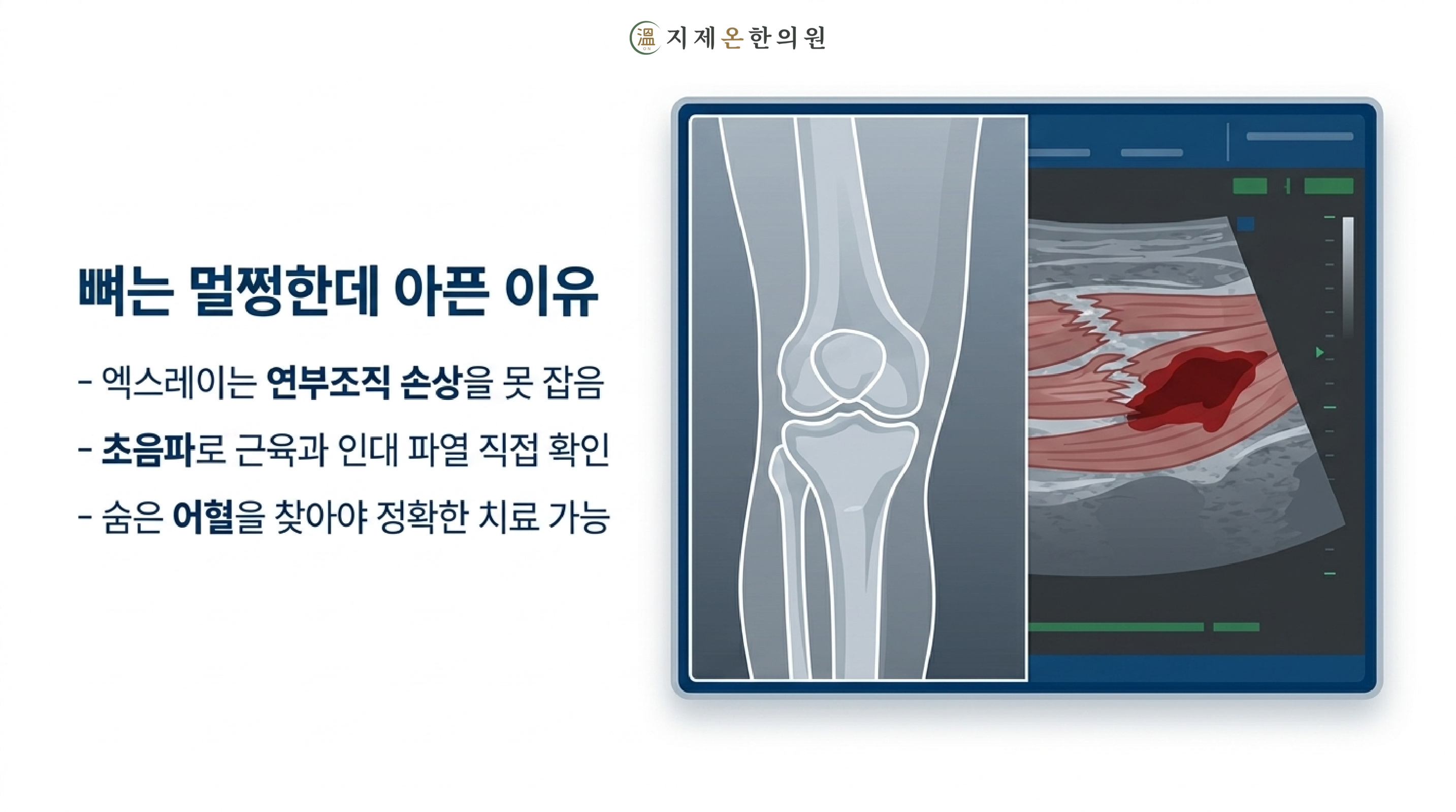뼈는 멀쩡한데 아픈 이유